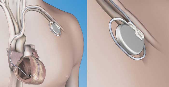 Can you use an aed on someone with a pacemaker Can You Use An Aed On Pacemaker Only In Emergencies Alsco Nz
