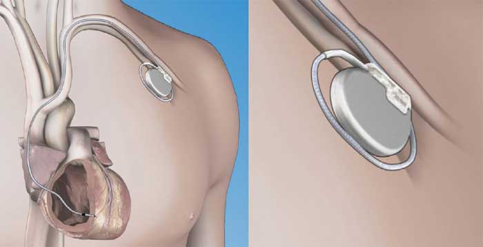 illustration of pacemaker transplant